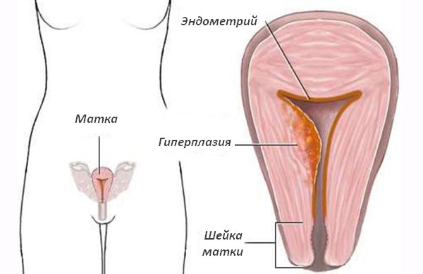 Гиперплазия эндометрия матки это рак или предрак: может перейти в тяжелую форму, диагностика и лечение современными медицинскими препаратами