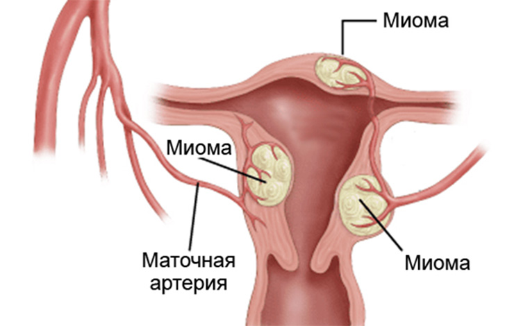 Гиперплазия эндометрия матки это рак или предрак: может перейти в тяжелую форму, диагностика и лечение современными медицинскими препаратами