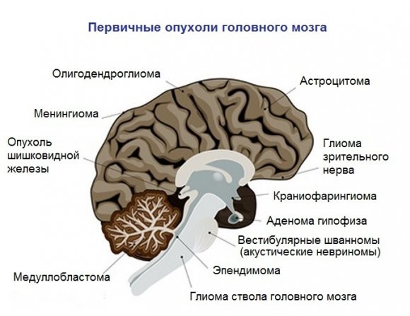 Глиома головного мозга: симптомы и диагностика, какие онкологи дают прогнозы, и что следует предпринять в первую очередь