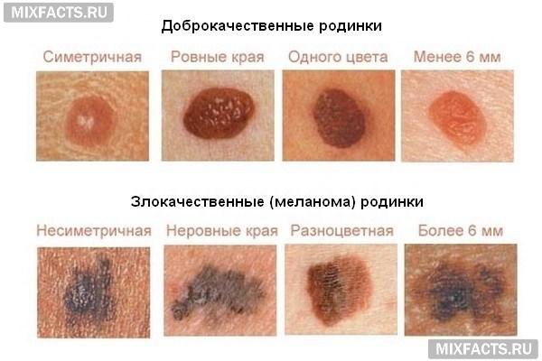 Опасные родинки: основные признаки меланомы, как распознать онкологию на ранней стадии Опасные родинки: основные признаки меланомы, как распознать онкологию на ранней стадии