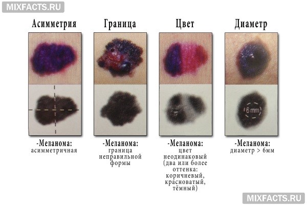 Опасные родинки: основные признаки меланомы, как распознать онкологию на ранней стадии Опасные родинки: основные признаки меланомы, как распознать онкологию на ранней стадии