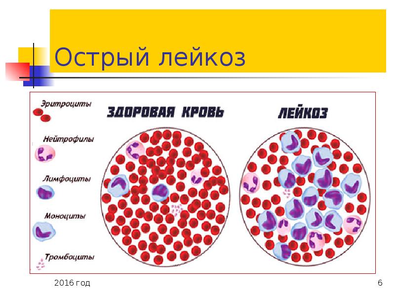 Острый лейкоз: причины развития, стадии и диагностика заболевания, прогнозы и ответы на популярные вопросы