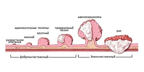 Передается ли рак по наследству: меры профилактики и генетическая предрасположенность к онкологическим болезням, первые симптомы заболевания
