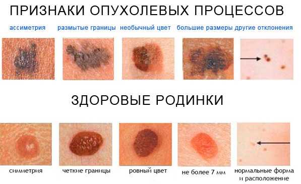 Прогноз при меланоме 4 стадии: продолжительность жизни, прогнозы профессиональных онкологов и способы лечения