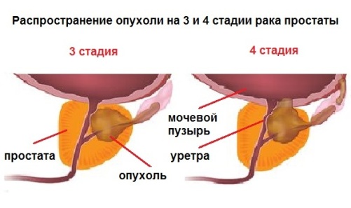 Продолжительность жизни при раке простаты 3 степени: агрессивность опухоли, эффективность различных видов лечения, метастазирование в другие ткани и врачебные прогнозы