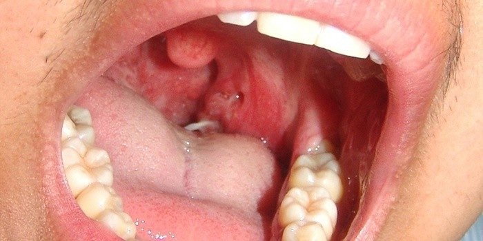Рак носоглотки: симптомы и признаки, методы лечения и прогнозы докторов на выживаемость пациентов разной стадии онкологии