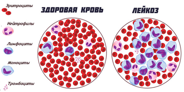 Белокровие: что это такое, признаки и причины заболевания, методы диагностики, способы лечения и народная медицина