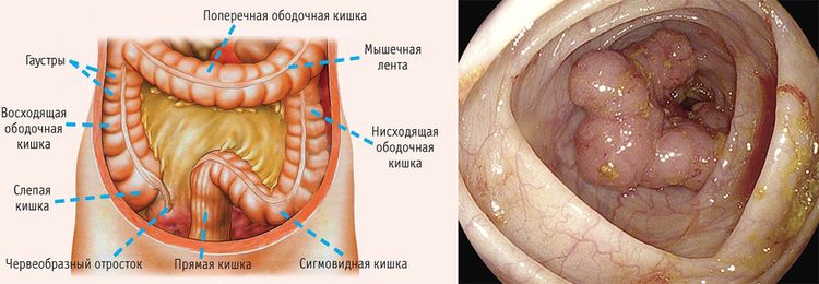 Код рака желудка в мкб 10 – c16: факторы риска, диагностика онкозаболевания, методы лечения и лекарства, которые используются в терапии рака желудка