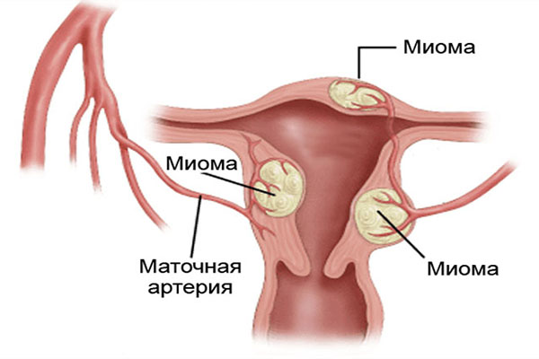 Может ли миома матки перерасти в рак: определение доброкачественной опухоли, предпосылки развития, шансы на малигнизацию образования