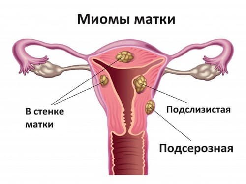 Может ли миома матки перерасти в рак: определение доброкачественной опухоли, предпосылки развития, шансы на малигнизацию образования