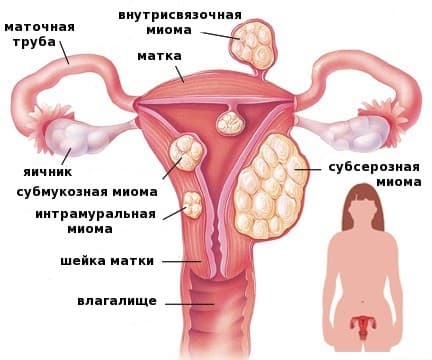 Может ли миома матки перерасти в рак: определение доброкачественной опухоли, предпосылки развития, шансы на малигнизацию образования