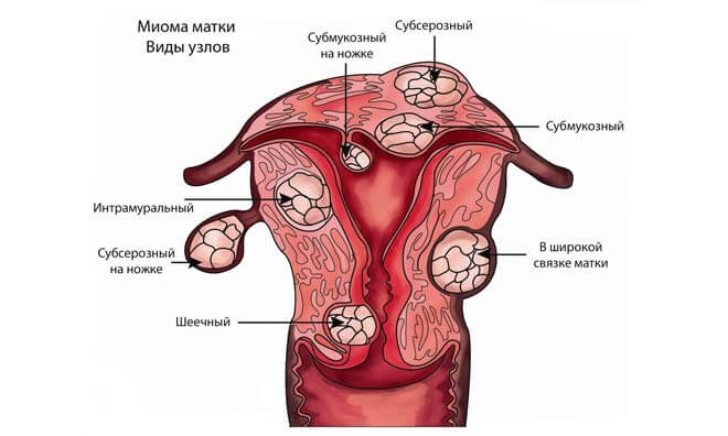 Может ли миома матки перерасти в рак: определение доброкачественной опухоли, предпосылки развития, шансы на малигнизацию образования