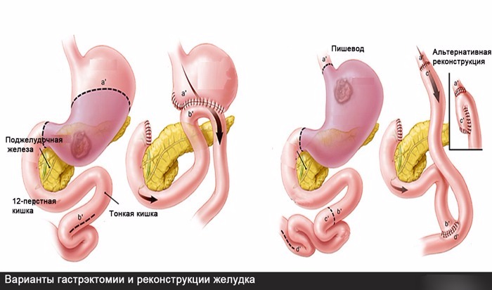 Операция при раке желудка: показания для процедуры, предварительная диагностика пациента и ход инвазивного вмешательства, восстановление пациента и диета, прогнозы