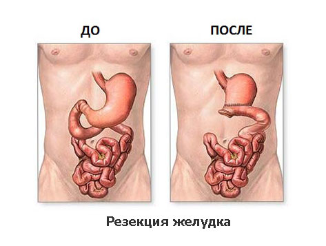 Операция при раке желудка: показания для процедуры, предварительная диагностика пациента и ход инвазивного вмешательства, восстановление пациента и диета, прогнозы