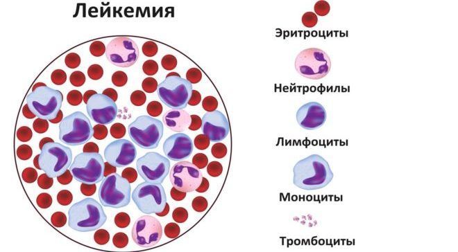 Острый миелобластный лейкоз: симптомы и диагностика патологии, эффективность лечения, особенности протекания заболевания у взрослых и детей