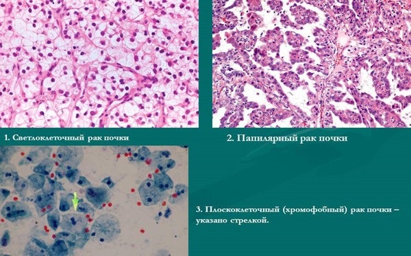 Светлоклеточный рак почки: симптомы и отличия от других заболеваний почек, причины возникновения, лечение и прогнозы на выздоровление