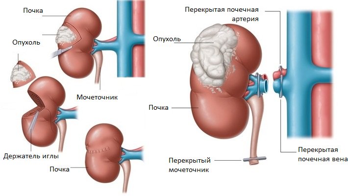 Светлоклеточный рак почки: симптомы и отличия от других заболеваний почек, причины возникновения, лечение и прогнозы на выздоровление