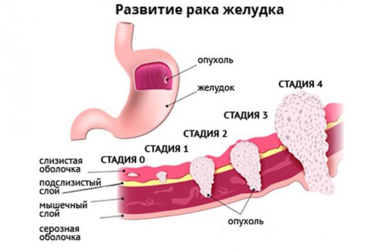 Стадии рака и его классификация: стадирование развития онкологии, детальная расшифровка международной терминологии
