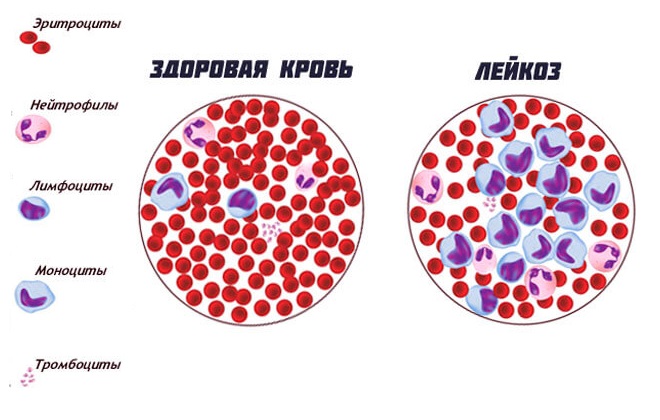 Стадии рака и его классификация: стадирование развития онкологии, детальная расшифровка международной терминологии