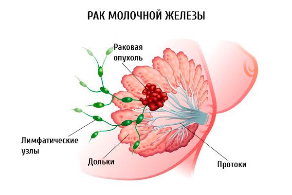 Трижды негативный рак молочной железы: особенности опухоли, предпосылки и диагностика рака, химиотерапия и хирургическое лечение агрессивной формы рака, прогноз