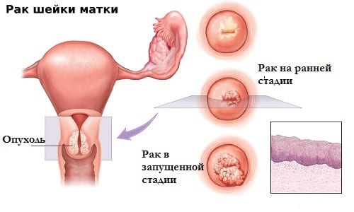 Прививка от рака шейки матки: эффективность и сравнение вакцин, особенности их применения, возможные побочные эффекты, схема иммунизации от рака