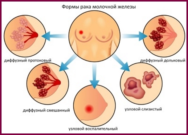 Протоковый рак молочной железы: формы онкологии, причины и предрасположенность, какие методы применяются для лечения онкопатологии, врачебные прогнозы