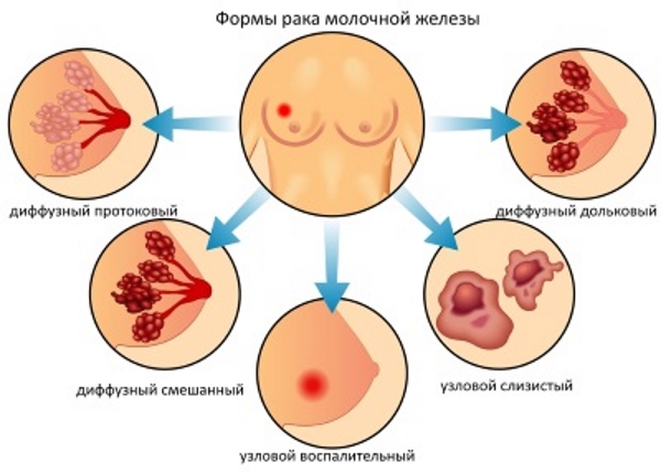 Протоковый рак молочной железы: формы онкологии, причины и предрасположенность, какие методы применяются для лечения онкопатологии, врачебные прогнозы