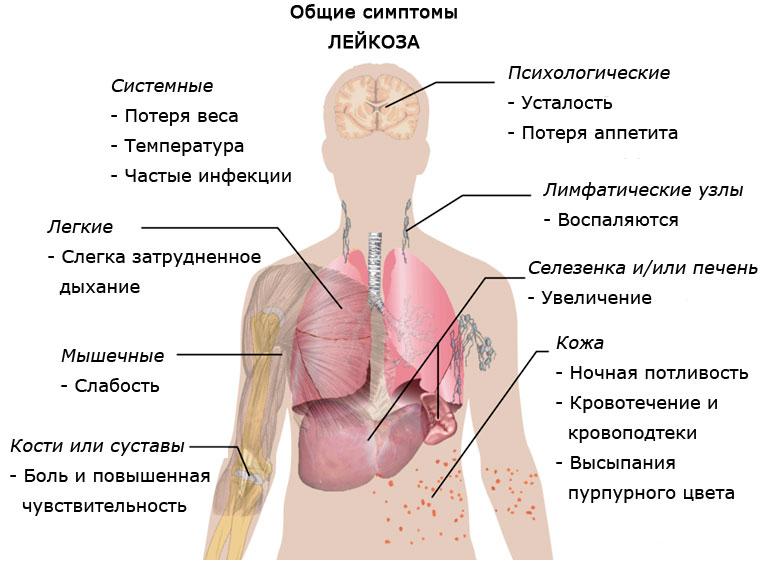 Что такое лейкемия: признаки и симптомы заболевания у детей и взрослых, классификация, лечение заболевания медикаментами и народными средствами