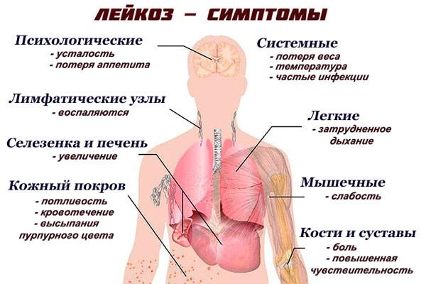 Что такое лейкемия: признаки и симптомы заболевания у детей и взрослых, классификация, лечение заболевания медикаментами и народными средствами