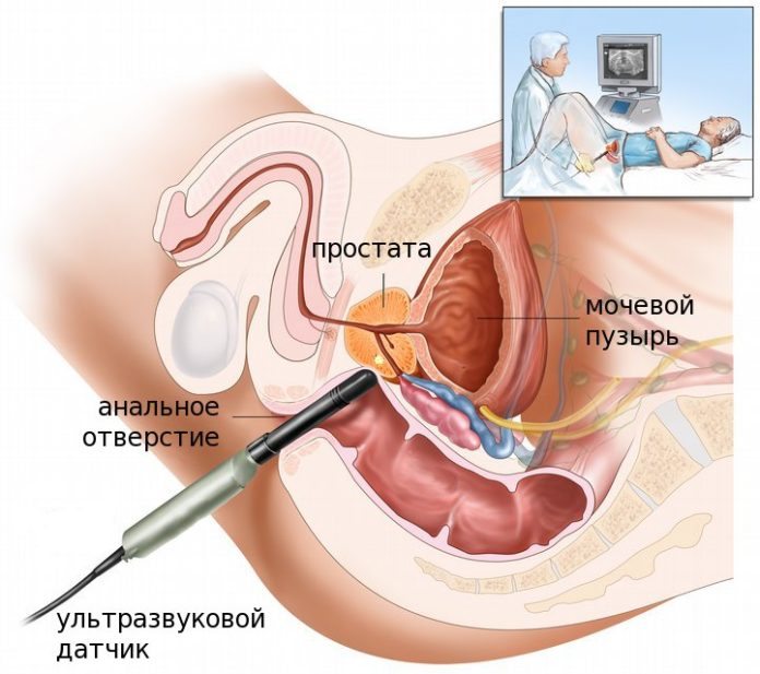 Рак предстательной железы (простаты): признаки и причины развития, диагностика заболевания, методы лечения