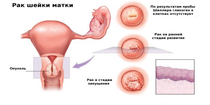 Аденокарцинома матки: формы заболевания, прогноз, симптомы и лечение паталогии, отзывы пациентов