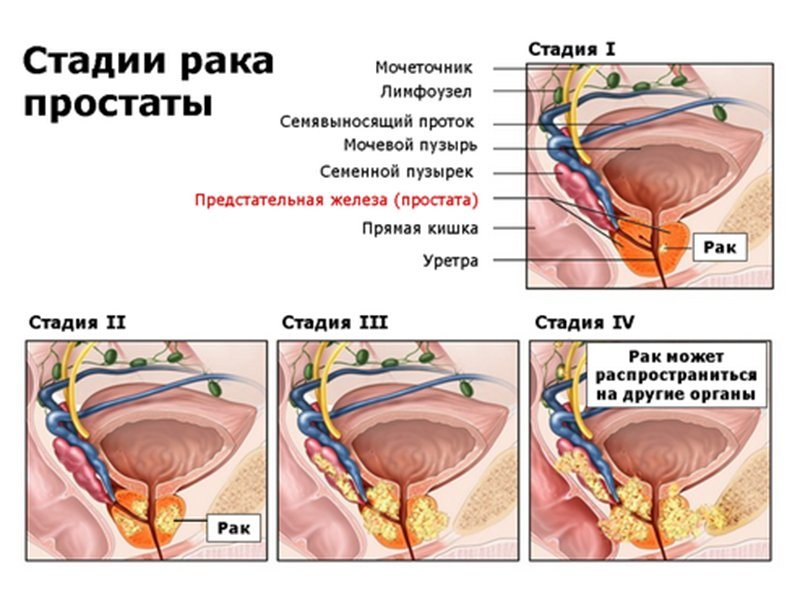 Рак предстательной железы 4 степени: симптомы, способы продления жизни и прогнозы выживаемости