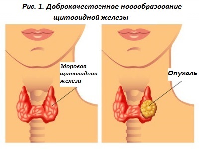 Виды и особенности доброкачественной опухоли: особенности и профилактика, стоит ли ее удалять, мнение врачей