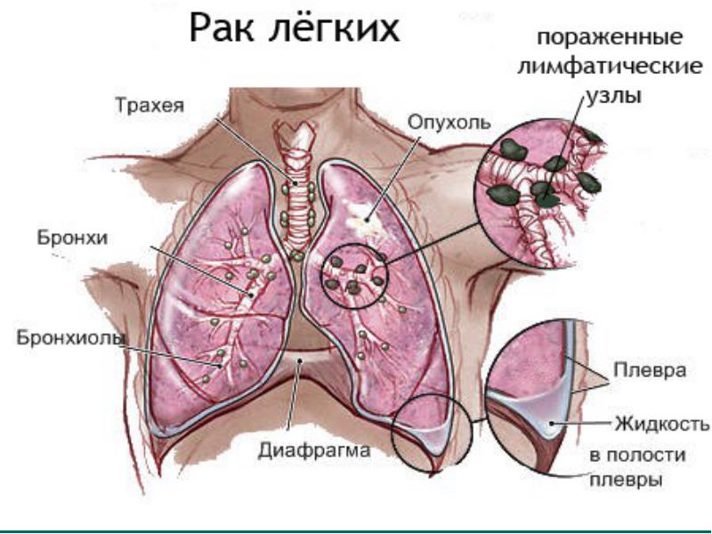 Температура при раке: причины, процесс лечения, когда следует немедленно обратиться за помощью к врачу