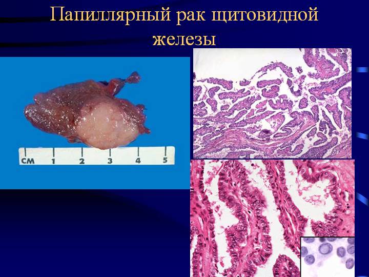 Папиллярная карцинома щитовидной железы: причины и особенности развития болезни, стадии и общая картина заболевания
