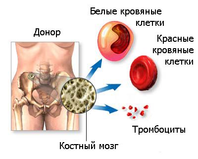 Рак костного мозга: виды и стадии заболевания, причины рака костного мозга, возможное лечение и прогнозы выживаемости