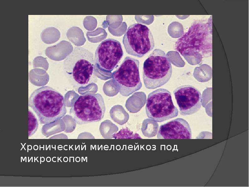 Рак крови: клиническая картина и виды рака крови, лечебная тактика, причины заболевания в детском возрасте и у женщин, сколько живут с раком крови