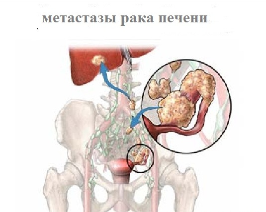 Рак печени 4 стадии: причины и признаки онкологического заболевания, прогноз и продолжительность жизни