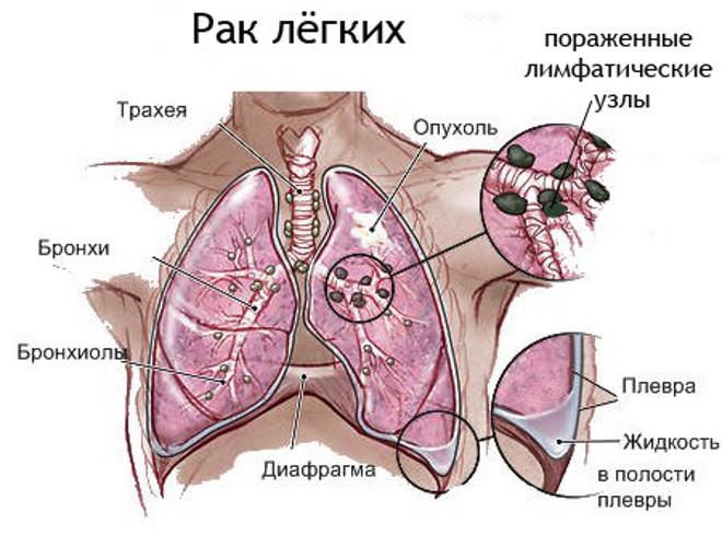 Рак печени 4 стадии: причины и признаки онкологического заболевания, прогноз и продолжительность жизни
