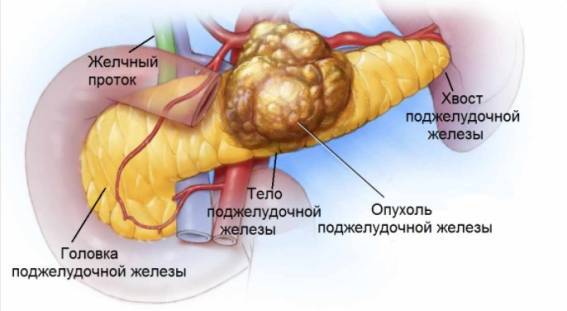 Рак поджелудочной железы 4 стадии: причины и признаки заболевания, особенности течения болезни, прогноз выживаемости