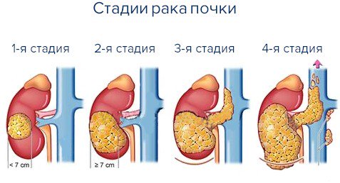 Рак почки: клиническая картина, симптомы и причины заболевания, лечебные процедуры