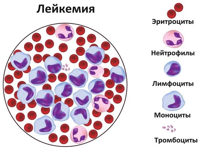 Волосатоклеточный лейкоз: какие прогнозы чаще всего дают врачи для жизни, какая выживаемость и лечение