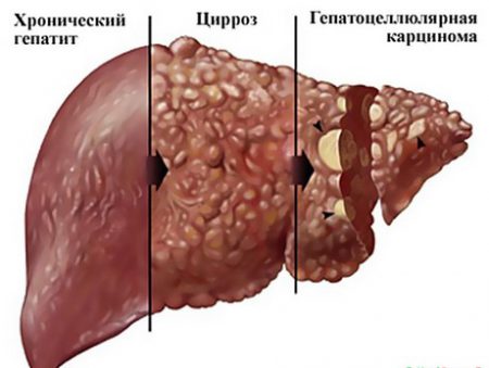 Гепатоцеллюлярная карцинома или рак печени: симптомы и лечение, профилактические меры и диагностика болезни