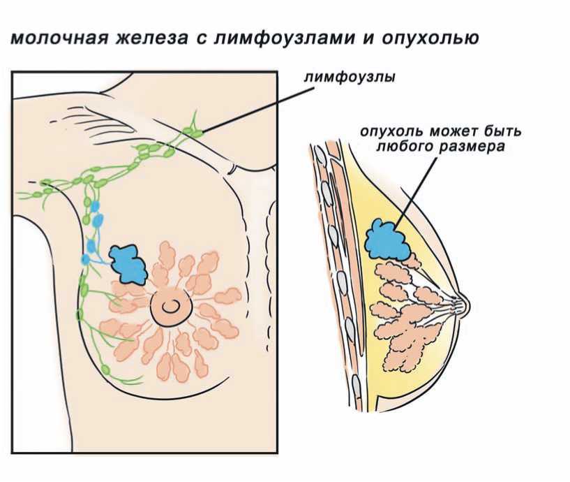 Диагностика гормонозависимой опухоли: причины возникновения и лечение, прогнозы врачей на выживаемость и восстановление организма
