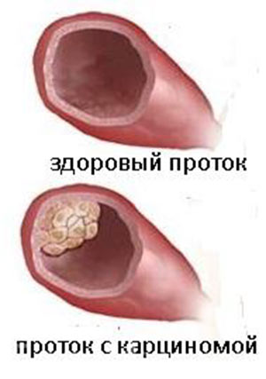 Инвазивная карцинома молочной железы: причины возникновения, разновидности и лечение онкологии