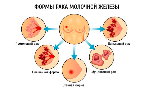 Инвазивная карцинома молочной железы: причины возникновения, разновидности и лечение онкологии
