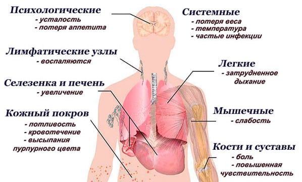 Лейкоз у взрослых: симптомы и прогноз жизни для пациентов, особенности лечения и рекомендации специалистов