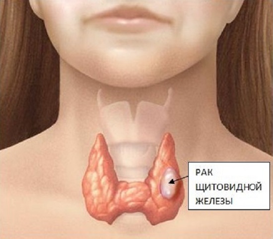 Медуллярный рак щитовидной железы: лечение и прогноз на выживаемость на разной стадии болезни, рекомендации врачей и способы лечения