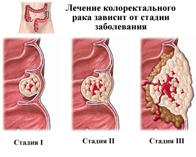 Колоректальный рак: симптомы и лечение онкологического заболевания, стадии и профилактика
