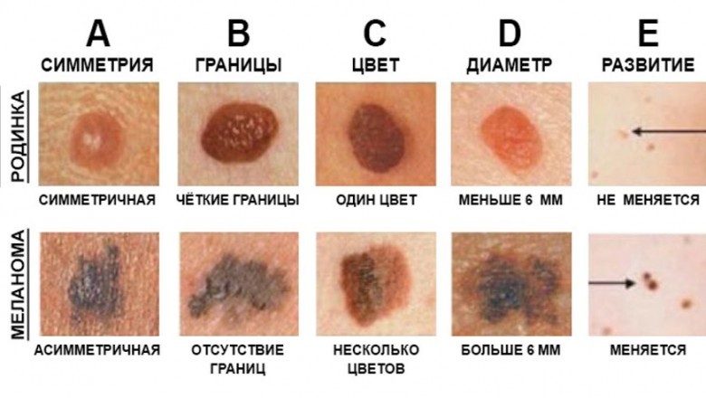 Меланома и код МКБ 10 – c43: отличие опухоли от обычной родинки, формы, особенности диагностики и лечения, врачебные прогнозы